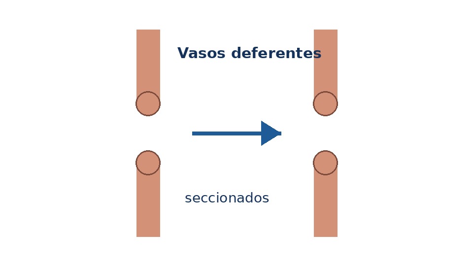 Esquema ilustrativo da vasectomia